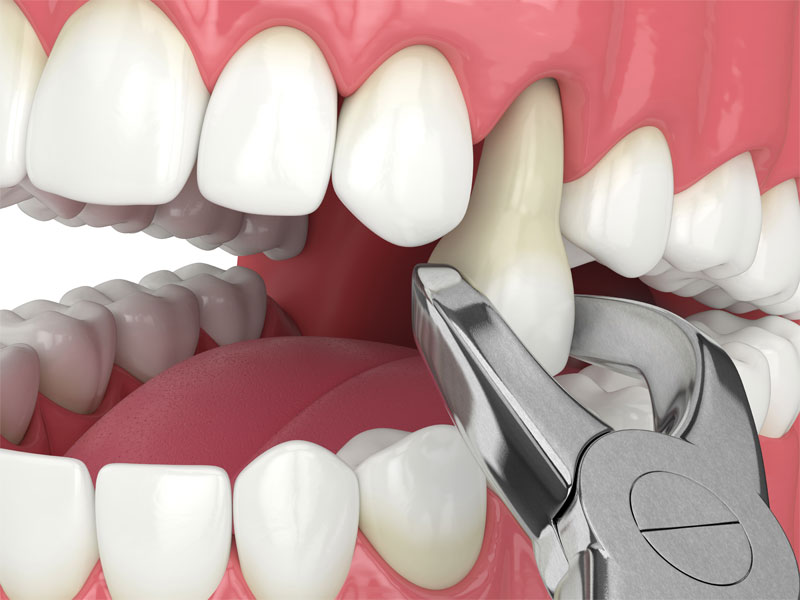 teeth-extraction-strip1